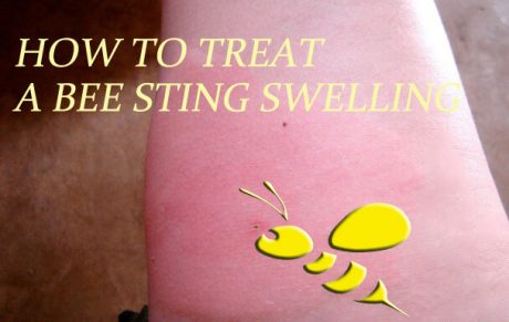 reduce swelling bumble bee sting
