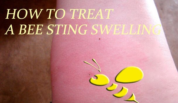 bee sting remedy natural